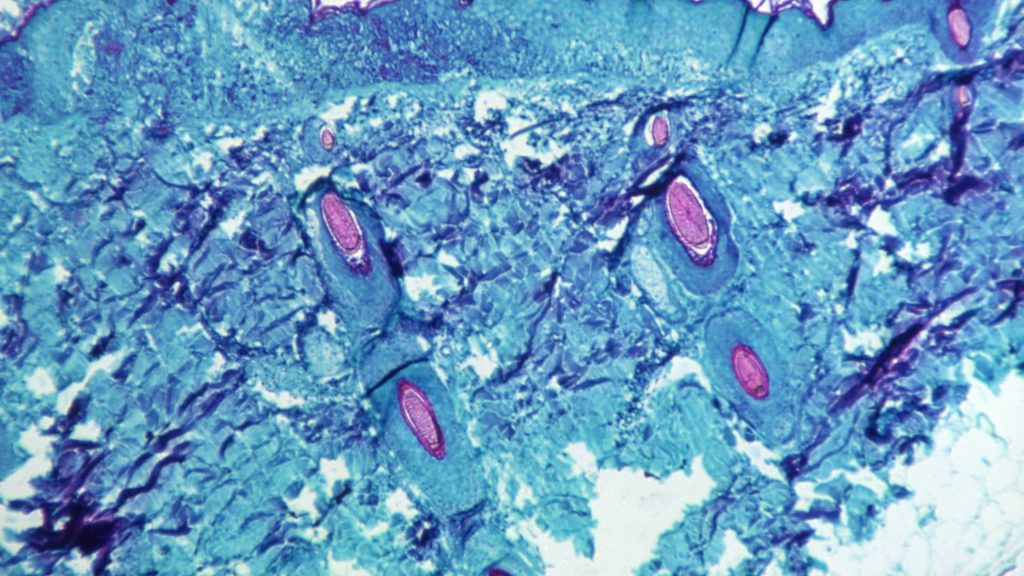 Texas Experiences What Will Be The First US Dying From Monkeypox • MV TELEGRAPH - Vimarsana News