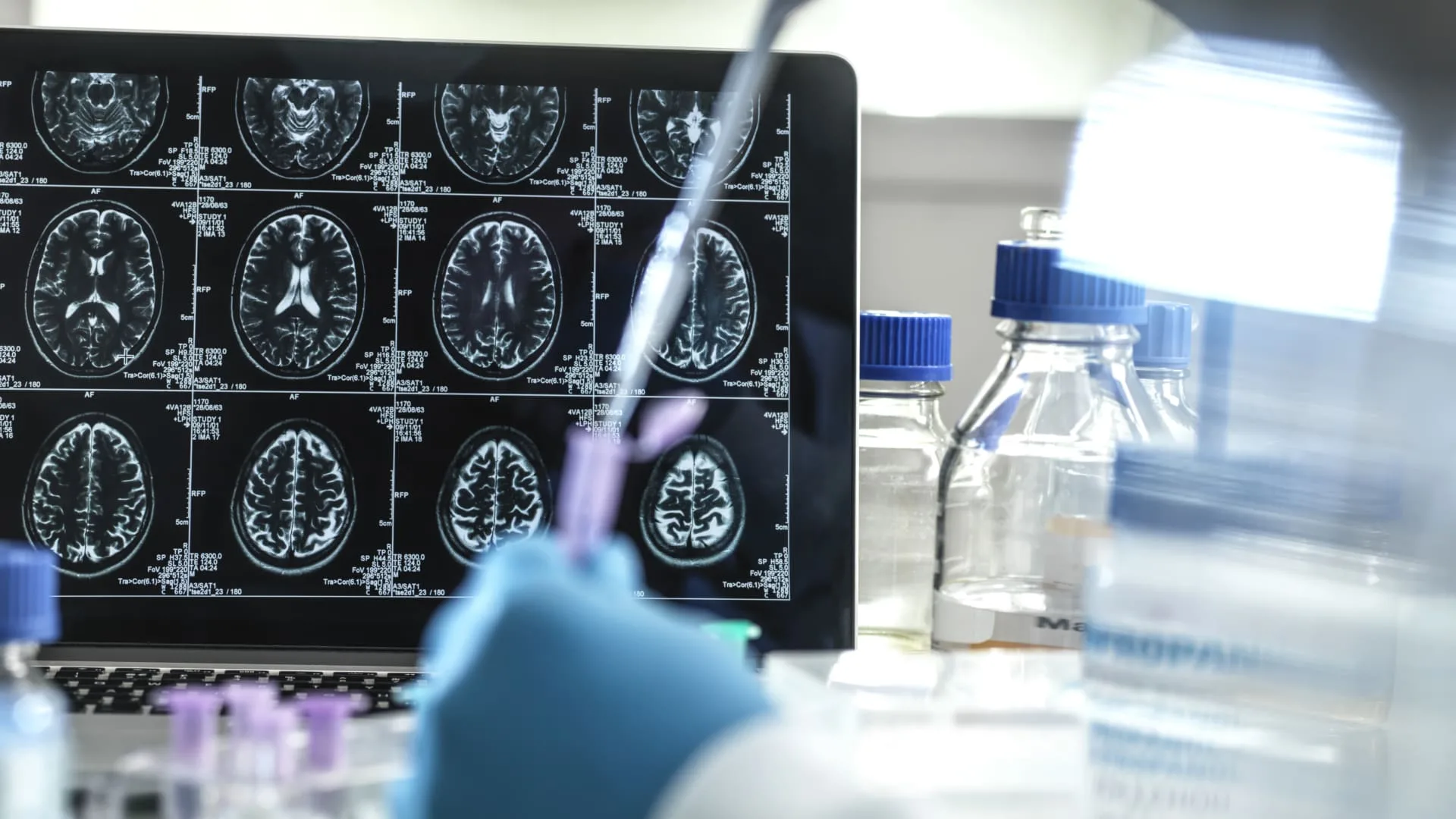 The maker of Alzheimer's drug Leqembi expects full FDA approval this summer