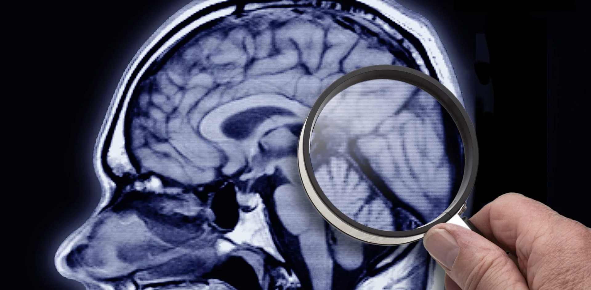 Obesity associated with Azheimer-like changes in the brain