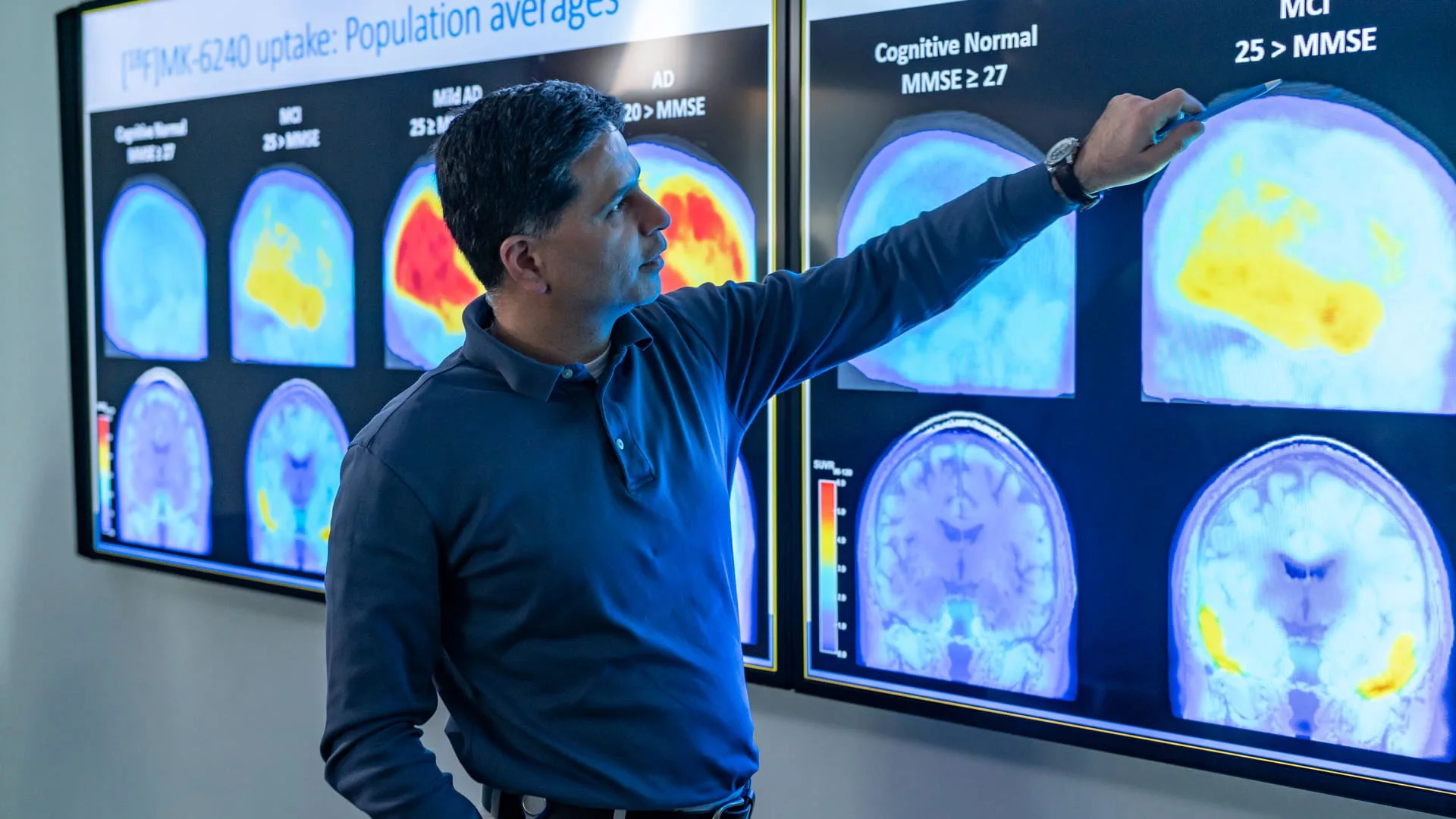 Alzheimer's patients see the benefits of Leqembi even when it is stopped